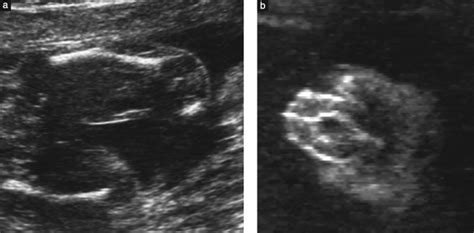 Features Of Campomelic Dysplasia Detectable On Ultrasound Include Download Scientific Diagram