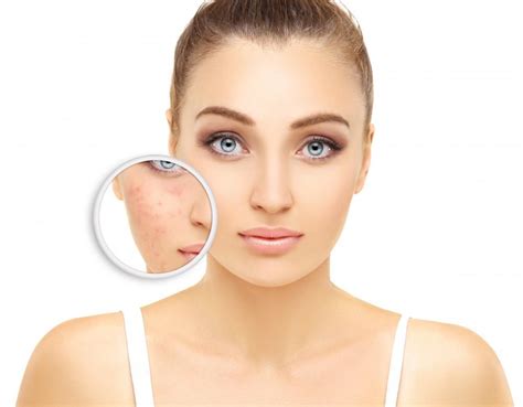 How Can I Stop Acne Once And For All David Rodriguez Md Dermatologist