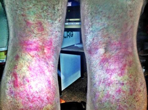 Eczema Eczema Behind Knees