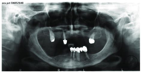 Unilateral Carotid Artery Calcifications In Circle On The Left