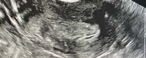 Pelvic Ultrasound Endometrial Thickness Pelvic Ultrasound My Xxx Hot Girl