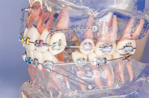 Microimplantes de ortodoncia - Clínica Dental Valvanera