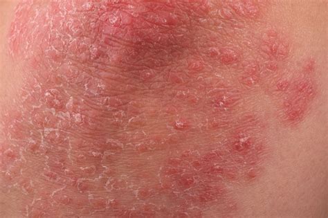 Psoriasis Drug Approved By Fda The Pharmaceutical Journal