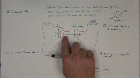 The pressure exerted by a solvent passing through a semipermeable membrane in osmosi. Edema: Part 1 - YouTube