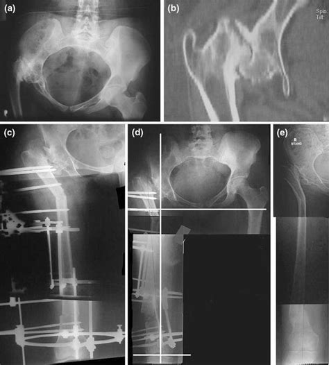 Preoperative Plain Radiograph And Ct Scan Show Destruction Of The