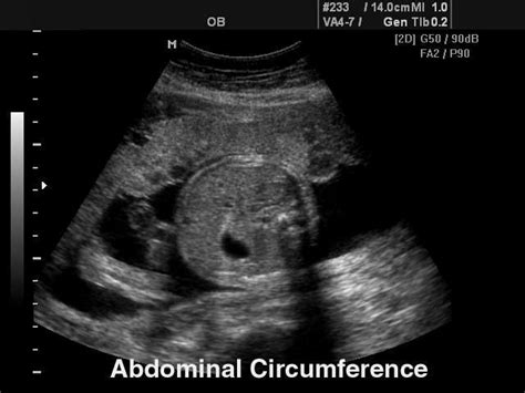 Ultrasound Images • Fetus Abdominal Circumference B Mode Echogramm №120