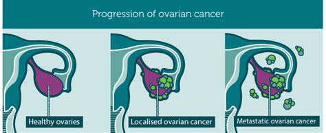 Top 8 Warning Signs Of Ovarian Cancer Women