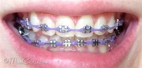 Power chains can be very similar to elastic ligatures. lilac/ lavender braces: power chain | Cute braces, Braces ...