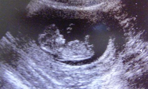 Semana 9 De Embarazo Aparece El Reflejo Patelar