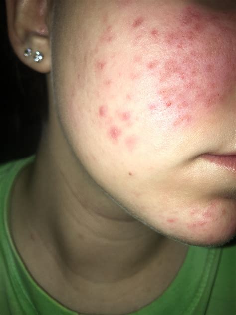 Irritated Enlarged Pores General Acne Discussion