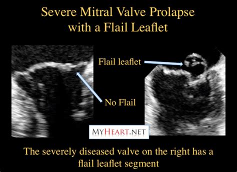 The Flail Leaflet And Mitral Valve Prolapse