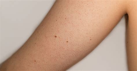 Keratosis Pilaris Skin And Laser Center Of Nj