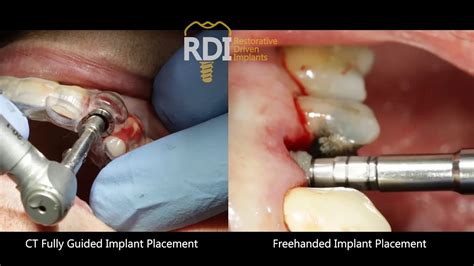 Restorative Driven Implants Ct Fully Guided Vs Free Handed Dental