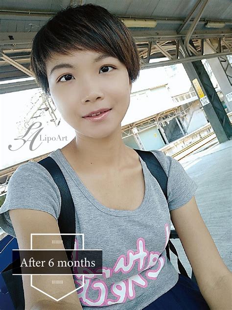 See more of 瘋蘋果 on facebook. 【Nina】玻尿酸蘋果肌+法令紋 - 萊波亞美醫診所LipoArt Aesthetic Clinic