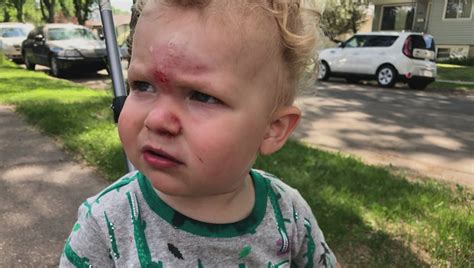 When Should Parents Be Worried About Head Bumps And Bruises In Kids