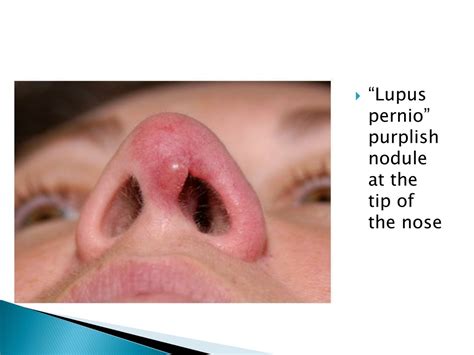 Ppt Granulomatous Disease Of Nose Powerpoint Presentation Free