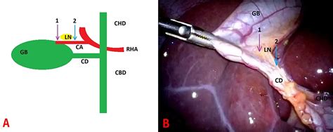 Cureus Inter Surgeon Variability In Cystic Artery Lymph Node Excision
