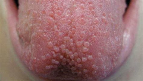 Bumps On Back Of Tongue And Throat