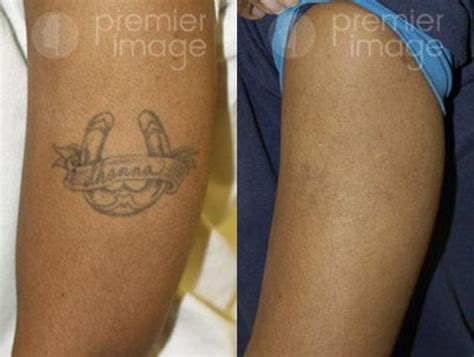 Tattoo Removal Before And After Photos Sandy Springs Ga Patient 16271