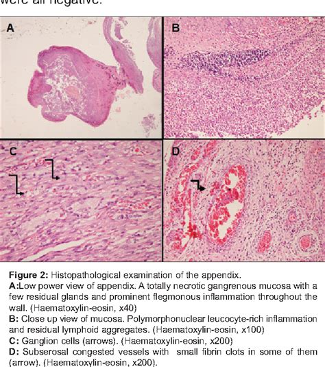 Figure 2 From Perforated Appendicitis After Intravenous Immunoglobulin