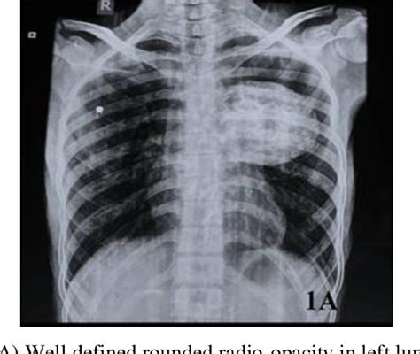 Figure 1 From Expansile Lytic Lesions Of Rib Two Rare Case Reports