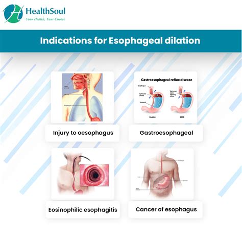 Esophageal Dilation Indications And Complications Healthsoul