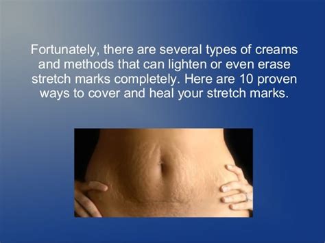 How To Fade Stretch Marks