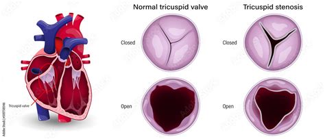 Valular Heart Disease The Difference Of Tricuspid Stenosis And Normal