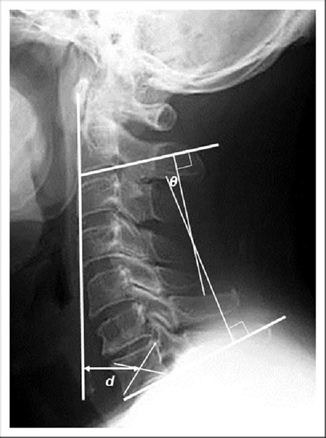 Radiographic Measurements Cervical Lordosis Y Indicates The Angle