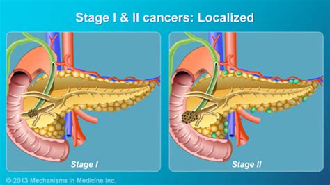 Pancreatic Cancer Pathophysiology Diagnosis And Staging