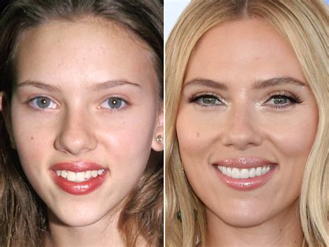 Scarlett Johansson Plastic Surgery Before And After Photos Follow News