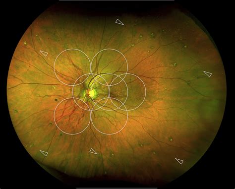 Ultra Widefield Imaging In Patients With Angioid Streaks Secondary To