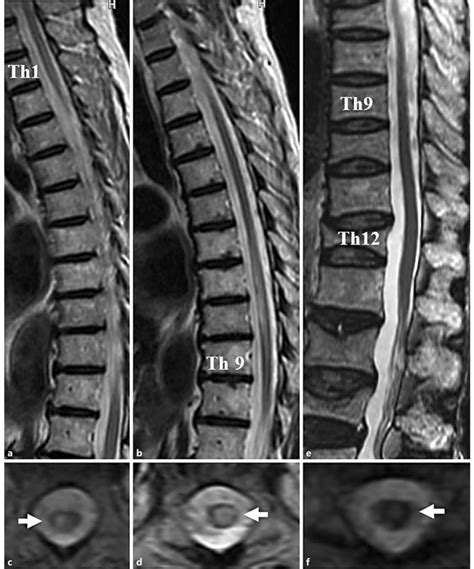 Sagittal Thoracic Spine Magnetic Resonance Imaging Mri On Admission