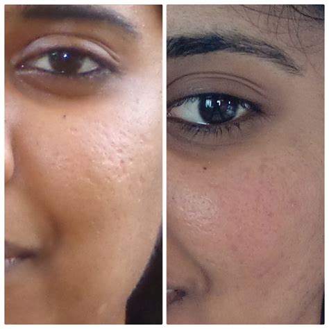 Albums 90 Images Dermabrasion For Acne Scars Before And After Pictures