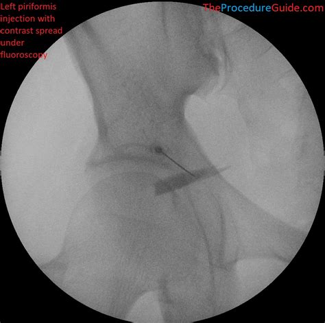Fluoroscopic Guided Piriformis Injection Technique And Overview The Procedure Guide