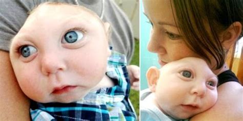 Baby Born With Part Of His Brain And Skull Missing Life With Styles