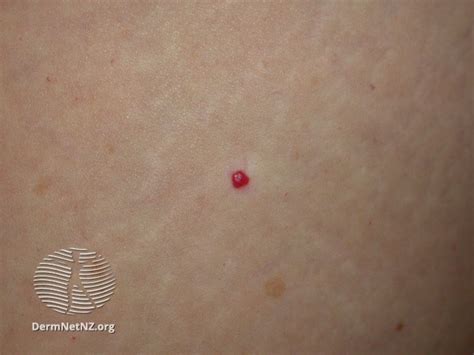 What Are Cherry Angiomas Symptoms Causes Treatments