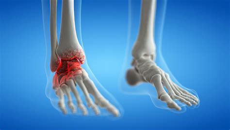 Understanding Ankle Arthritis And Non Surgical Options For Treatment