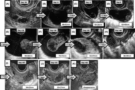 The Chronological Change In Transvaginal Ultrasound Images Of A Hemorrhagic Ovarian Cyst
