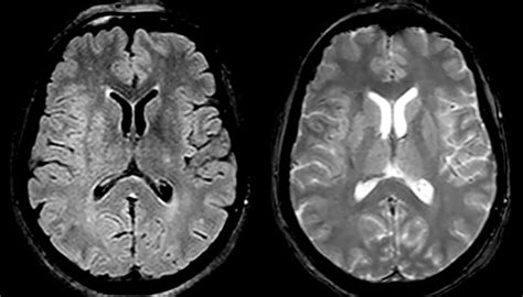 Mri In Ms Stroke Brain Tumor Fieldstrength Mri Philips