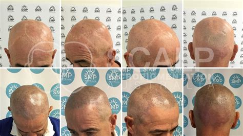 Pin On Scalp Micropigmentation Australia Hair Loss Treatment