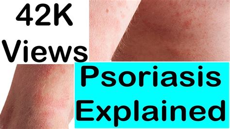 Psoriasis Explained What Causes Psoriasis And How To Treat Psoriasis