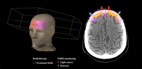 Measuring Changes In Brain Tissue Oxygenation For Personalized Cancer