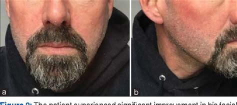 Figure 2 From A Case Report Of An Eczematous Facial And Neck Rash As A