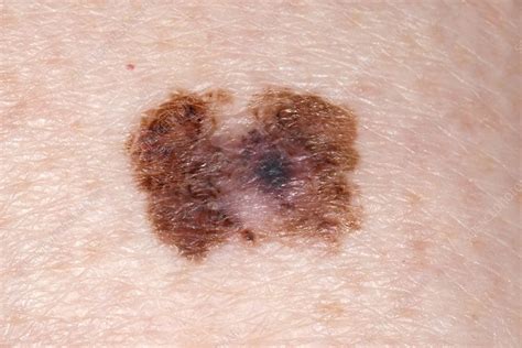 Skin Cancer Stock Image C0230717 Science Photo Library