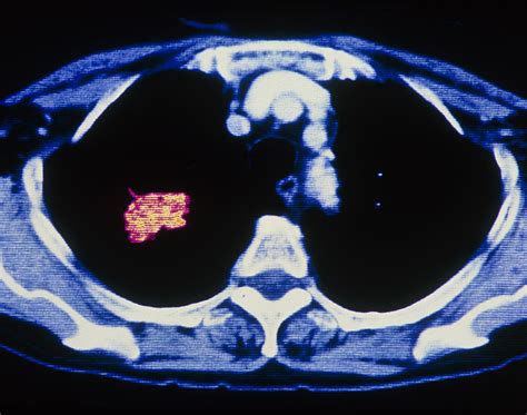 Coloured Ct Scan Showing Cancer Of A Lung Photograph By Pasieka Fine