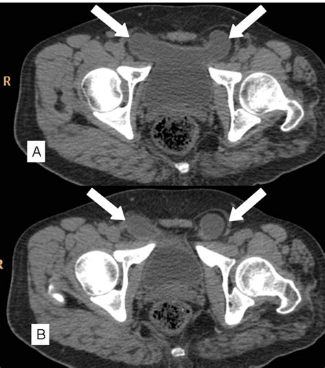 Bilateral Inguinal Hernia Containing Urinary Bladder As Sole Content