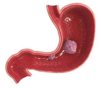 A stomach tumor can grow through the stomach's outer layer into nearby organs, such as the liver, pancreas, esophagus, or intestine. Stomach Cancer (Gastric Cancer)