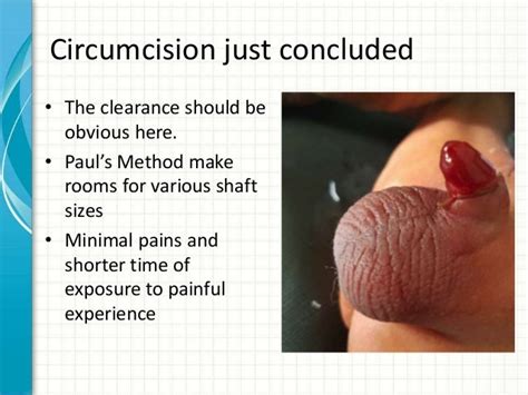 The Benefits Of A Circumcision Ring Chicagojewishnews Com