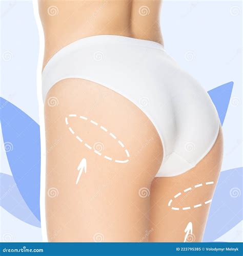 Marks On The Woman S Buttocks Legs Before Plastic Surgery Lifting